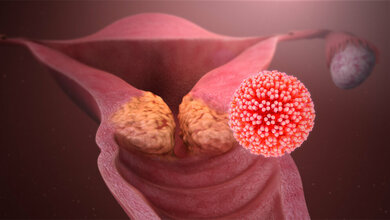 Gebaermutterhalskrebs_durch_HPV_scientificanimations_Creative_Commons_BY_SA.jpg Gebärmutterhalskrebs