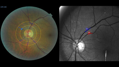 Long COVID Diagnostik