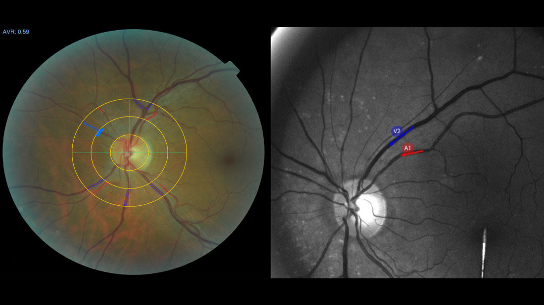Long COVID Diagnostik
