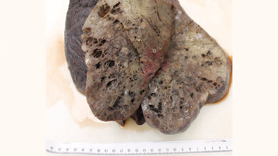 Mikroskopisch_sichtbare_ausgedehnte_Fibrosierung_Uniklinikum_Augsburg.jpg Sichtbare ausgedehnte Fibrosierung