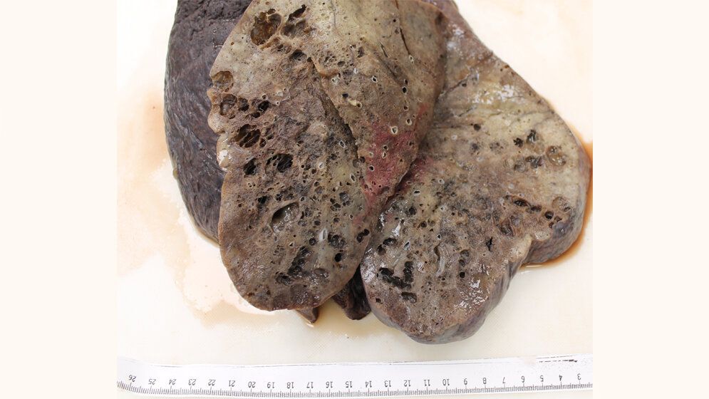 Mikroskopisch_sichtbare_ausgedehnte_Fibrosierung_Uniklinikum_Augsburg.jpg Sichtbare ausgedehnte Fibrosierung