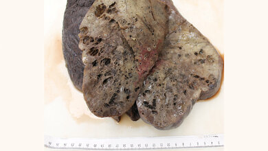 Sichtbare ausgedehnte Fibrosierung 