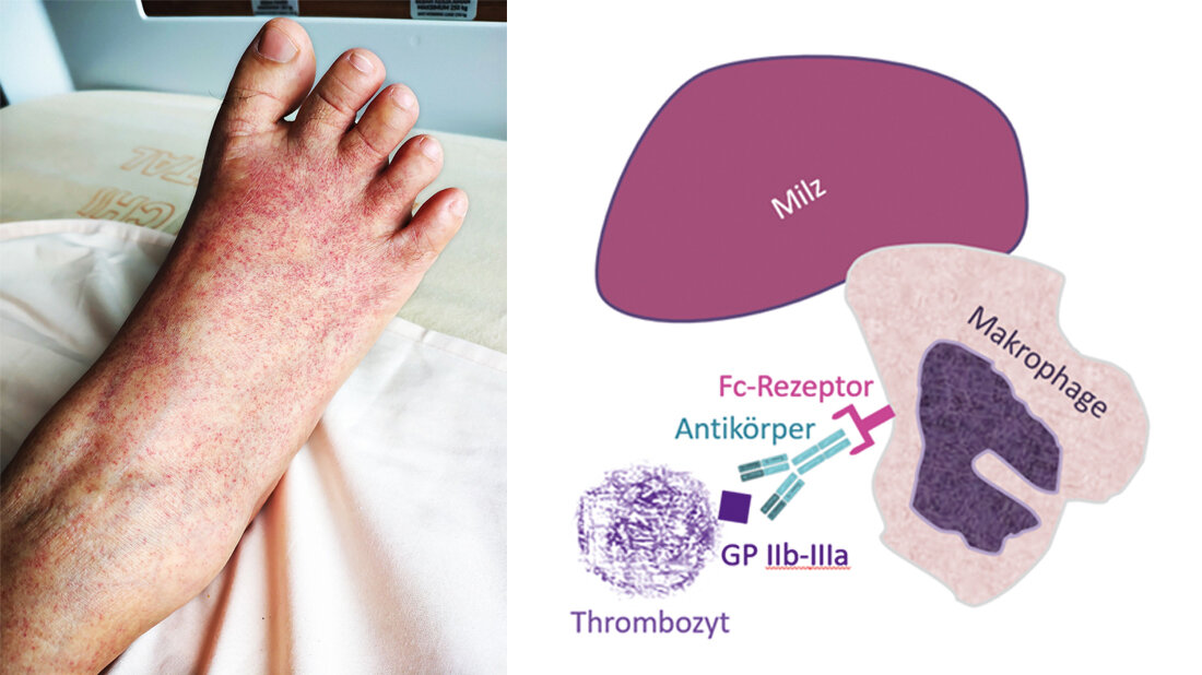 Abbildungen zum Erscheinungsbild und zur Ätiologie einer Immunthrombozytopenie
