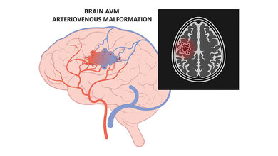 Symboldarstellung einer zerebralen arteriovenösen Malformation