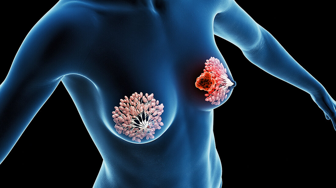 Reduzierung der Intervallkarzinomrate Titelbild des Beitrags über die Ergebnisse des Córdoba Breast Tomosynthesis Screening Trial