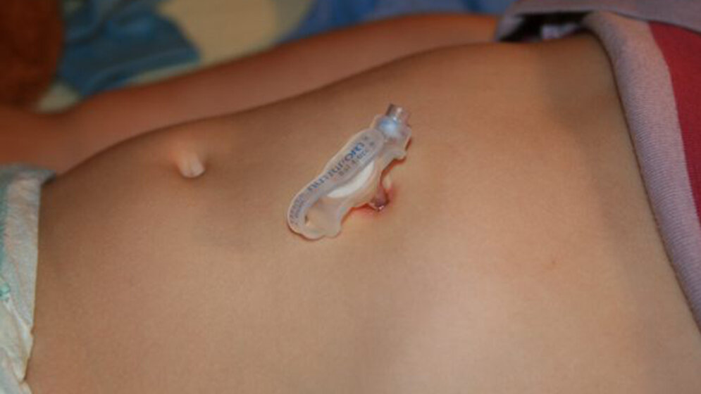 Perkutane Gastrostomie Konsequente Hygiene