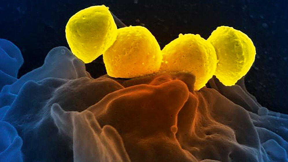 A-Streptokokken in der Geburtshilfe