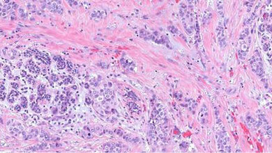 Adenokarzinom_der_Mamma.jpg Adenokarzinom der Mamma