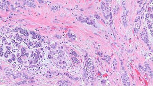 Adenokarzinom der Mamma