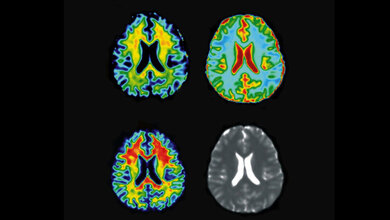 Krebsfrueherkennung_mit_Glukose_MRT_Klaus_Scheffler_MPI_biologische_Kybernetik_Tuebingen_24022016.jpg MRT-Bildgebung des Gehirns
