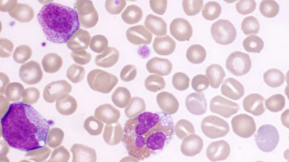 Stomatozyt – Der überwässerte Erythrozyt
