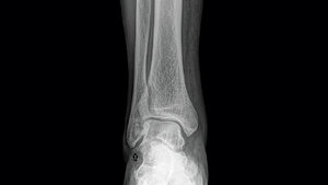 Anomalien und Normvarianten – Skelettale Veränderungen 3.21