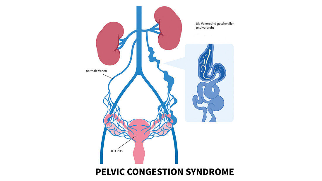 Schematische Darstellung des Becken-Kongestionssyndroms