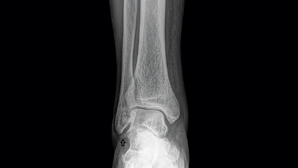 Anomalien und Normvarianten – Skelettale Veränderungen 3.21