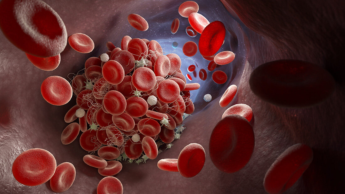 Thrombose_und_Immobilitaet.jpg Was Blutgerinnsel bei Immobilität verhindert