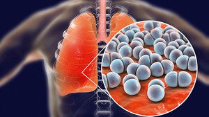 Titelbild des englischen Beitrags über Pneumonien