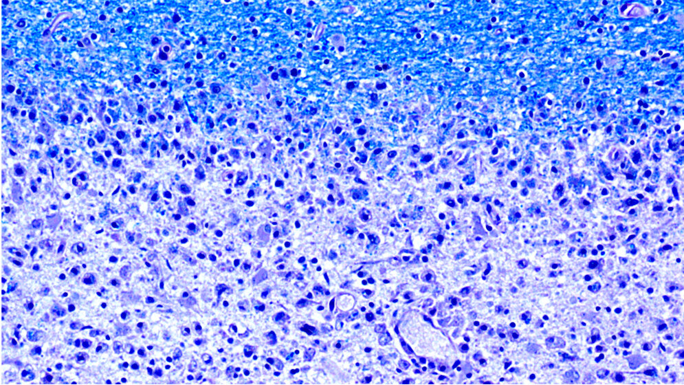 Schwindende_Nervenhüllen_Bild_Dr_med_Imke_Metz_Uni_Goettingen_Deutschland.jpg Schwindende Nervenhüllen