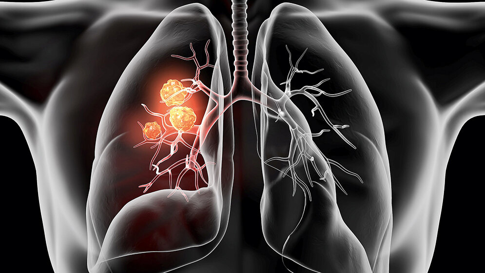 Lungenkrebs