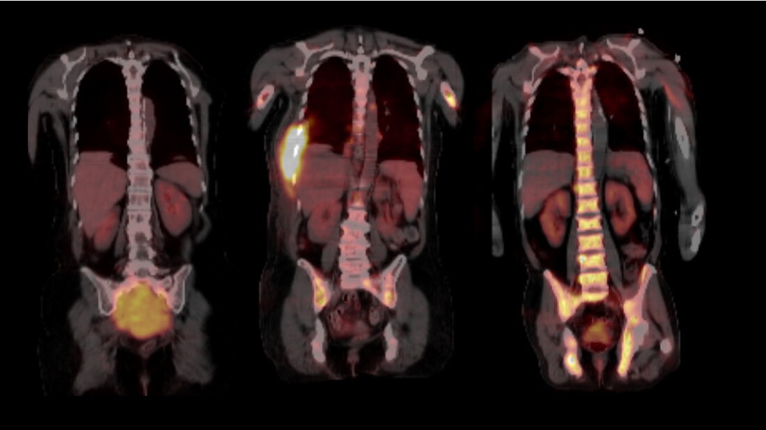 Positronen-Emissions-Tomografie (PET) genutzt
