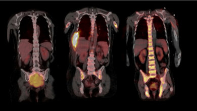 Positronen-Emissions-Tomografie (PET) genutzt