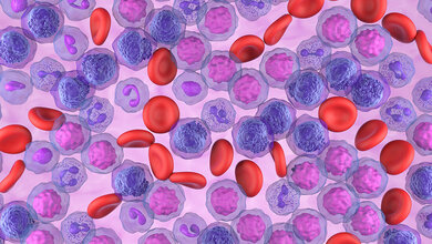 AML_Leukaemie.jpg Multizentrische Studie zur Kombinationstherapie gegen Leukämie gestartet