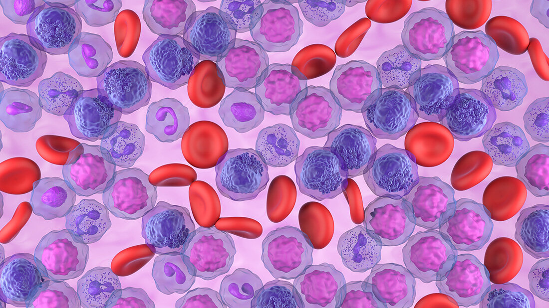  Multizentrische Studie zur Kombinationstherapie gegen Leukämie gestartet