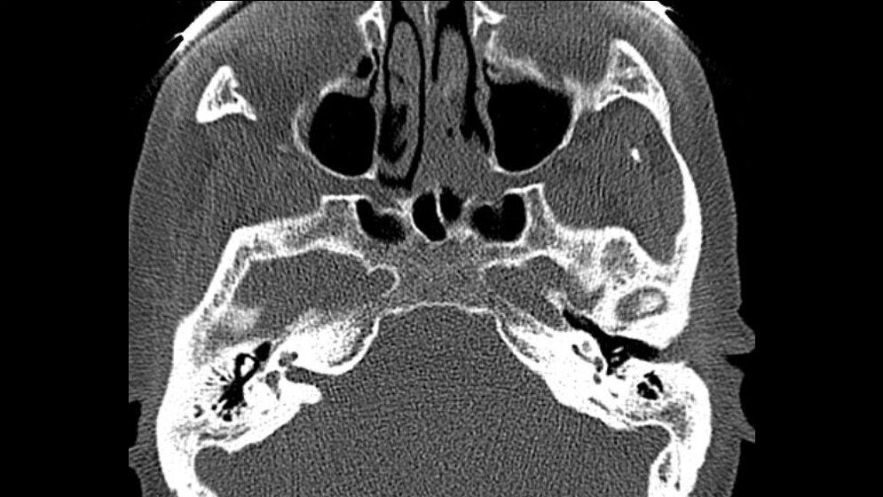 Anomalien und Normvarianten – Skelettale Veränderungen 3.12