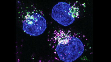 Menschliche Krebszellen