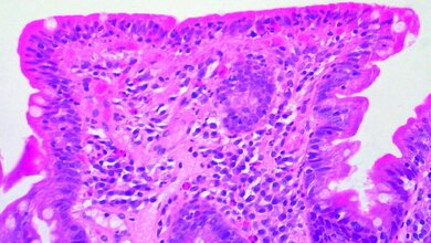 Serologische und histologische Diagnostik der Zöliakie 
