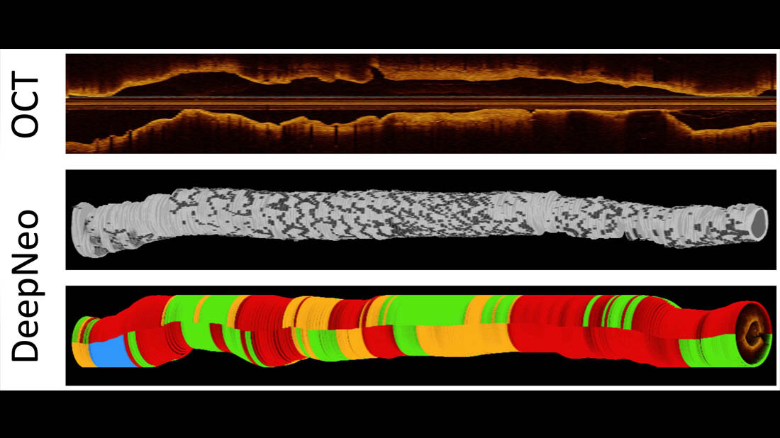 Es wird die Anwendung von DeepNeo gezeigt. Die untere Abbildung zeigt die Klassifizierung durch DeepNeo: Blau markiert nicht auswertbare Bereiche, Grün steht für homogene Neointima, Orange kennzeichnet heterogenes Gewebe, und Rot weist auf Neoatherosklerose hin.
