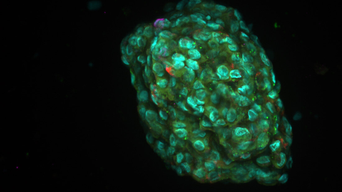 Organoidmodell eines Tumors. 