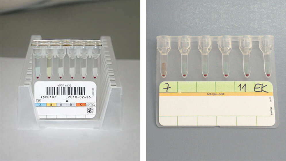 Das Säulenagglutinationsverfahren zur Blutgruppenbestimmung