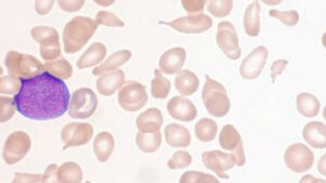 Tränentropfen-Erythrozyten