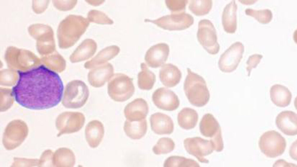 Hämatologie Tränentropfen-Erythrozyten