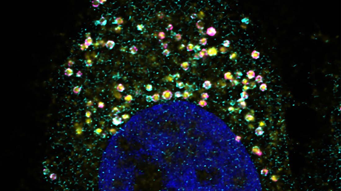 Zellabfall.jpg Was, wenn wenn die zellulären Mülleimer nicht funktionieren?