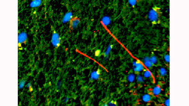 Zelltypen MS-Läsionen