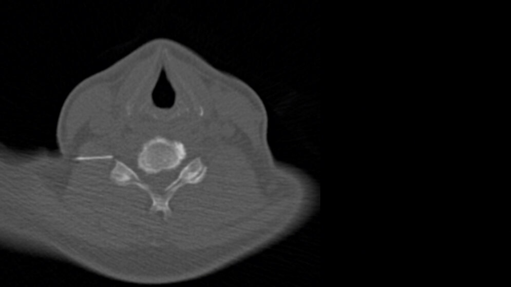 CT-gestützte periradikuläre Therapie (PRT)
