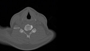 CT-gestützte periradikuläre Therapie (PRT)
