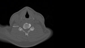 CT-gestützte periradikuläre Therapie (PRT)