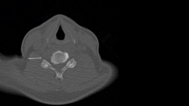 Strahlentherapie CT-gestützte periradikuläre Therapie (PRT)