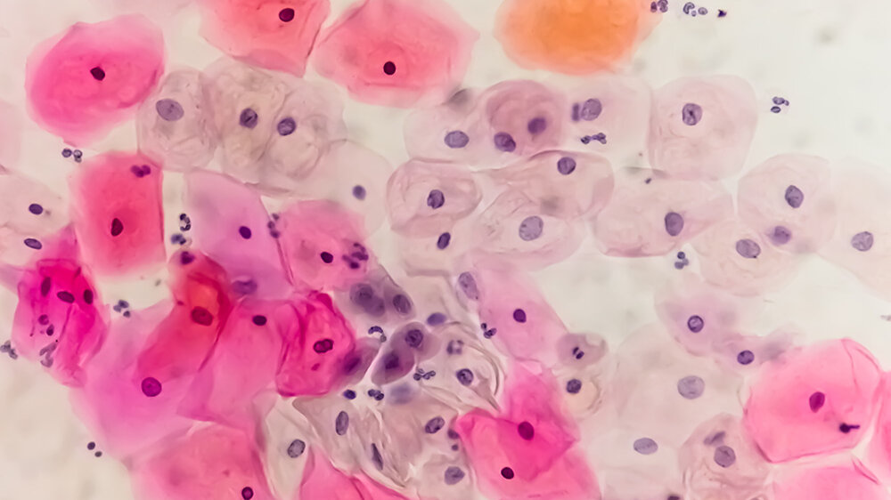 Gebaermutterhalskrebs.jpeg Gebärmutterhalskrebs