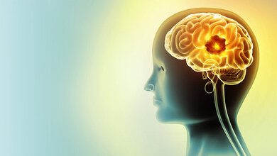 Grafische Darstellung vor hellblauem Hintergrund eines Kopfes mit sichtbarem Gehirn mit Hirntumor.