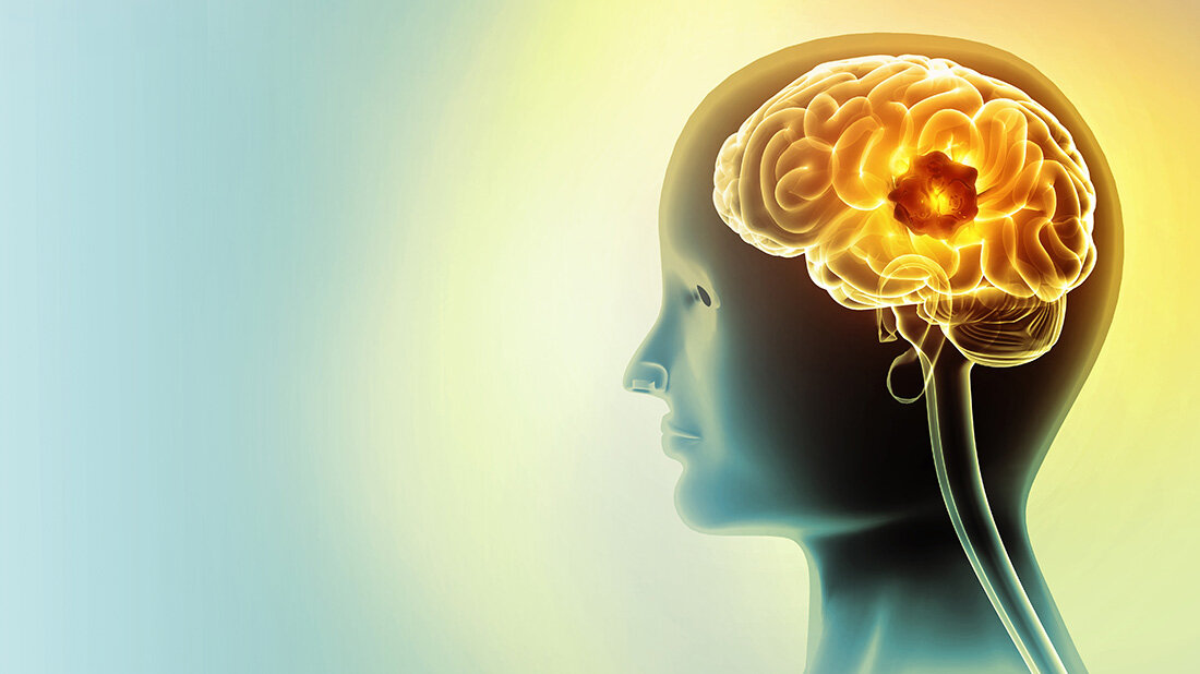 Grafische Darstellung vor hellblauem Hintergrund eines Kopfes mit sichtbarem Gehirn mit Hirntumor.