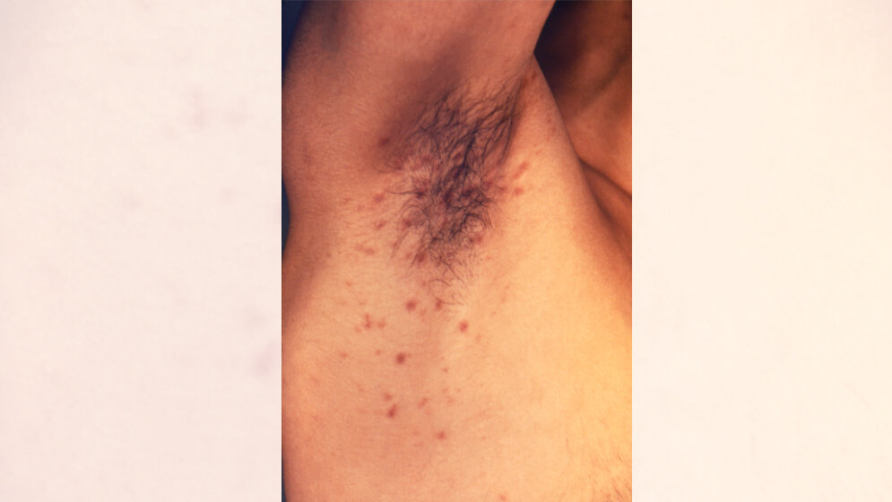 Kraetze_CDC_Susan_Lindsley_public_domain.jpg Krätze