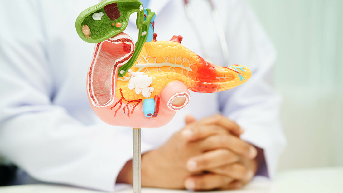 Bauchspeicheldrüsenkrebs