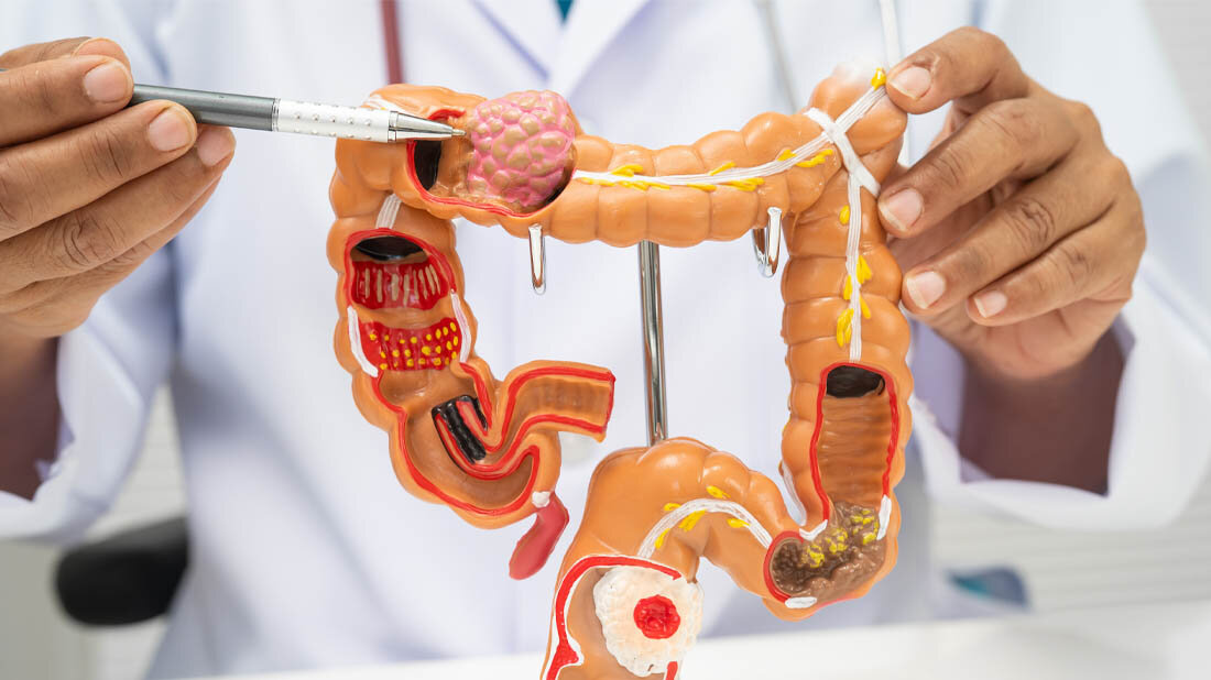 Darmkrebs_besser_behandeln.jpg Arzt zeigt in einem Modell auf den Darmtumor.