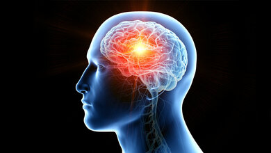 Stereotaktischer Radiochirurgie bei Hirnmetastasen