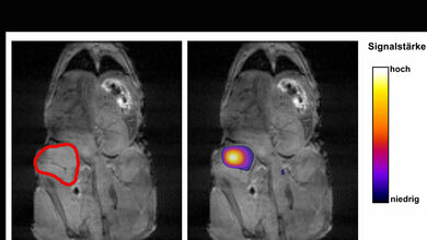 Nach Injektion des signalvertärkten Stoffwechselprodukts leuchtet spezifisch die Tumorregion auf.