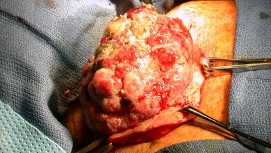 Rezidivierendes malignes Melanom