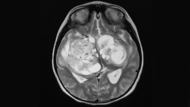 Strahlenempfindlichkeit von Hirntumorzellen